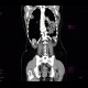 Lymphoma of the lung and spleen: CT - Computed tomography